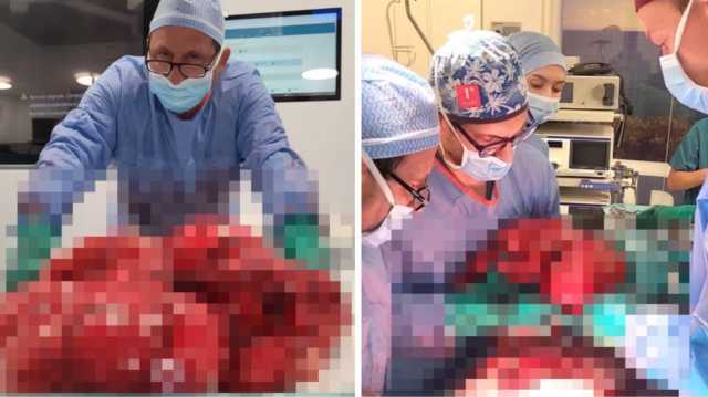 Incredibile operazione al Mater Olbia: asportato un tumore di 12 chili